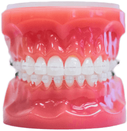 model-clear-braces