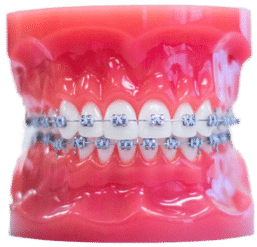 model-metal-braces