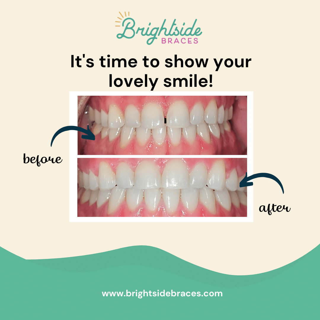 Brightside Braces Image 1